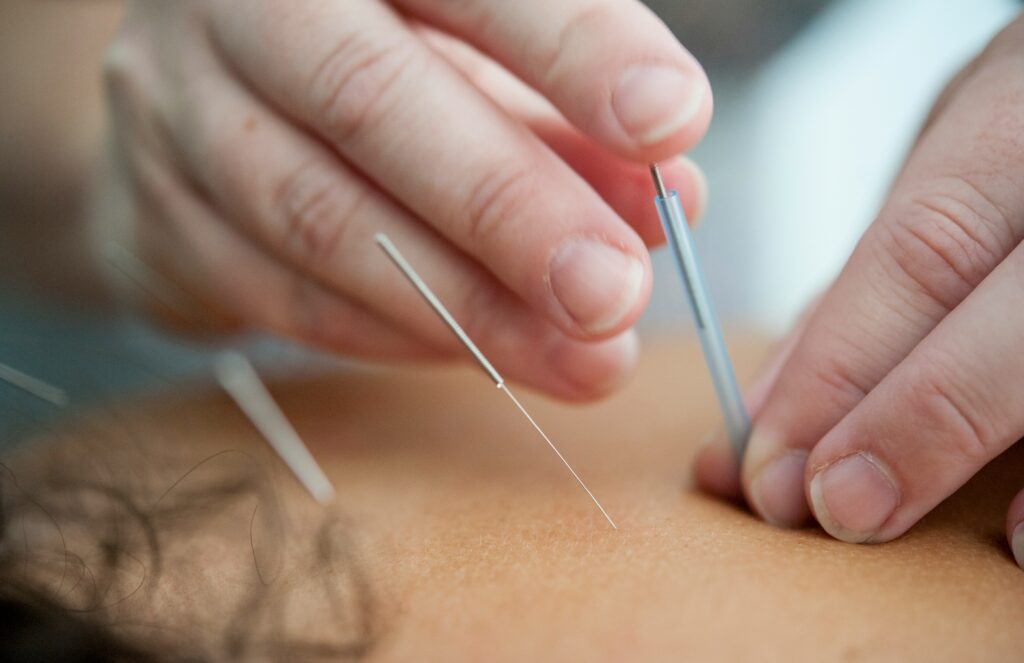 hands putting acupuncture needles into back